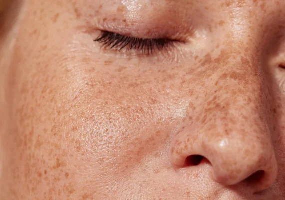 Beauty Heaven Microneedling